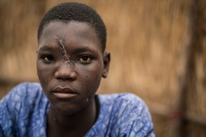 Toudjani Boulama, 18, was treated by MSF for the wound he received to his face after he was shot by a member of Boko Haram in Cameroon.