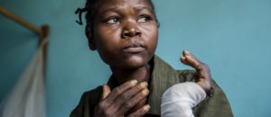 Ntumba Kasomba, 31, is sitting on a hospital bed in Ditekemena health centre. Ntumba arrived at the centre after spending half a year hiding in the bush. Photo: Marta Soszynska/MSF