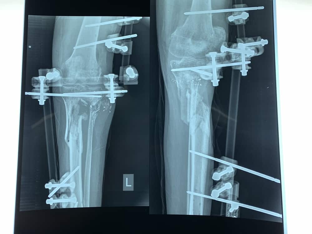 An x-ray shows the bone gap and external fixators in the leg of Yousri*, who was shot by the Israeli army during protests in Gaza in July 2018. Al-Awda Hospital. *name has been changed © JACOB BURNS/MSF
