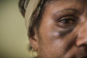 A patient consulting at the family support centre in Port Moresby following inter-partner violence. © Yann Libessart/MSF