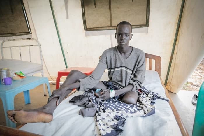 Banywich Bone, 18, had his leg amputated at Agok hospital following a severe infection after being bitten by a snake. Photo: Pierre-Yves Bernard/MSF